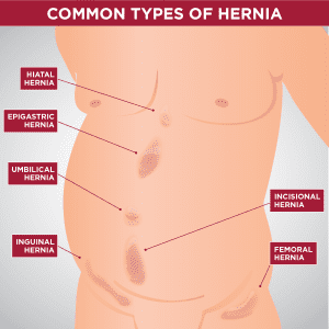 Types-of-Hernia-Diseases