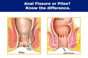 fissure vs piles