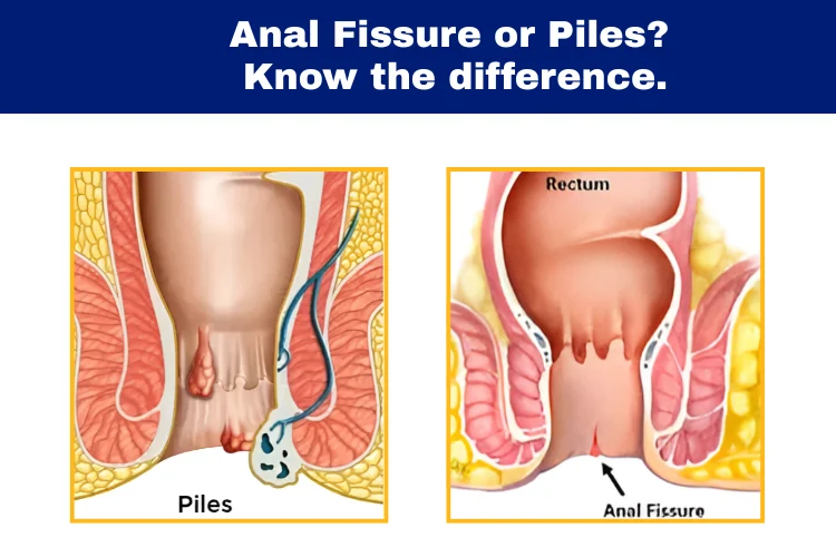 fissure vs piles