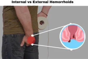 internal vs external hemorrhoids comparison
