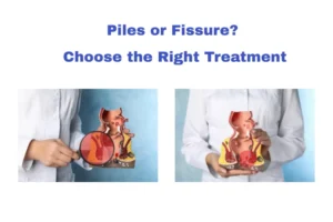 Piles or Fissure