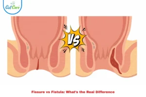 fissure vs Fistula