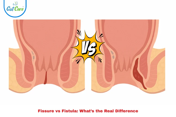 fissure vs Fistula