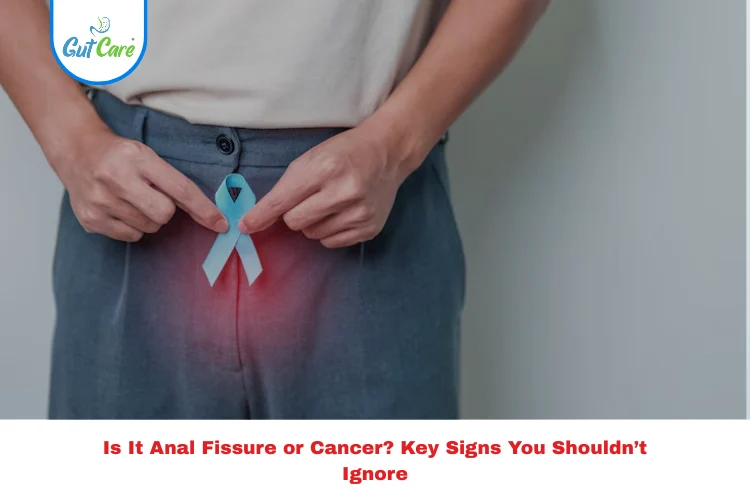 Anal fissure or cancer?