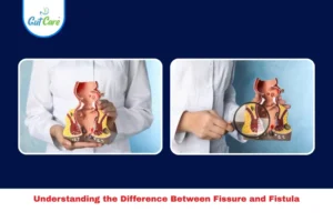 Difference Between Fissure and Fistula