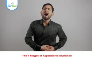 4 Stages of Appendicitis