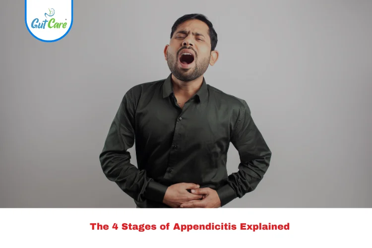 4 Stages of Appendicitis
