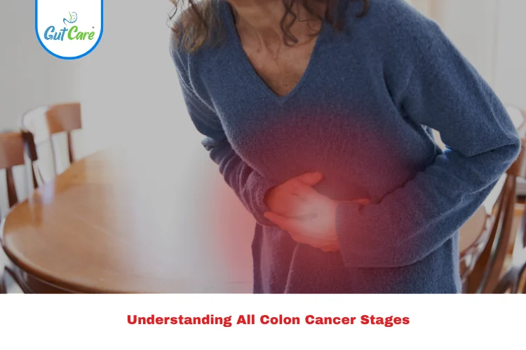 colon cancer stages