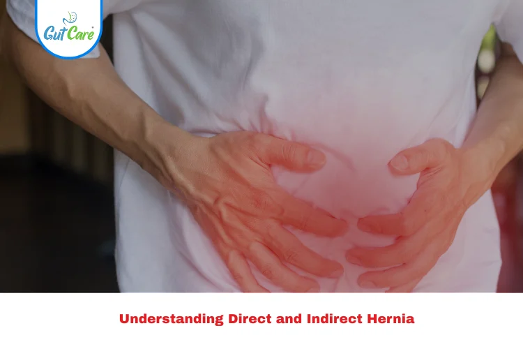 direct and indirect hernia