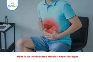 Paraumbilical Hernia