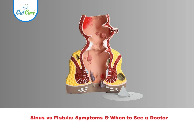 Sinus vs Fistula