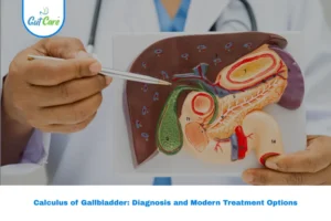 Calculus of Gallbladder