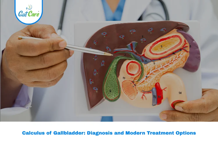 Calculus of Gallbladder