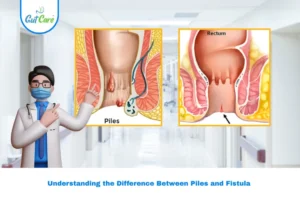 Difference Between Piles and Fistula