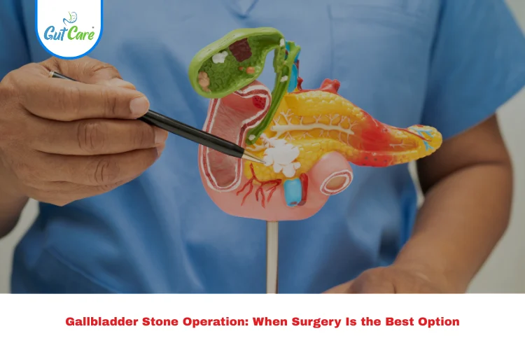 gallbladder stone operation