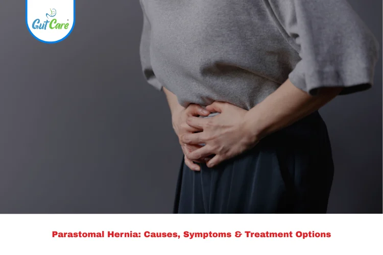 Parastomal Hernia