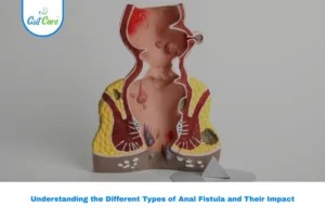 types of fistula