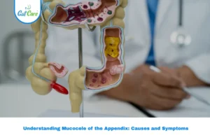 Mucocele Appendix
