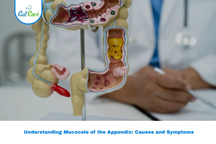 Mucocele Appendix