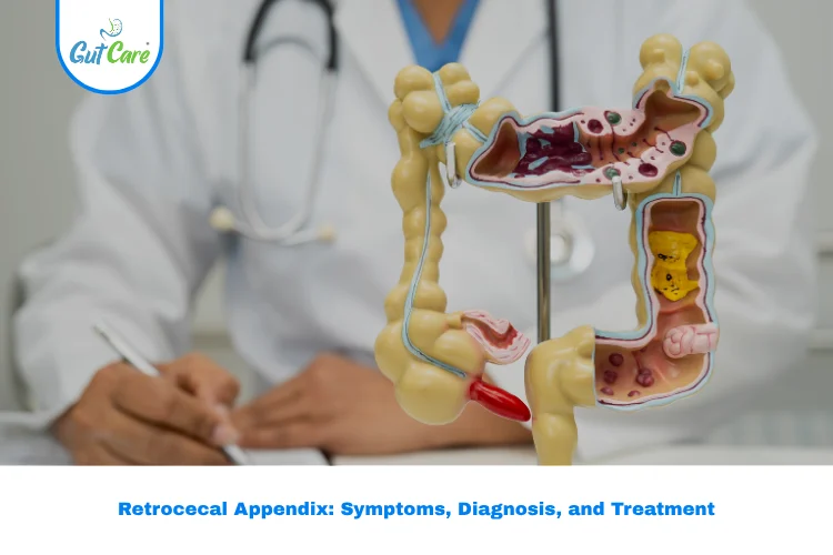 Retrocecal Appendix