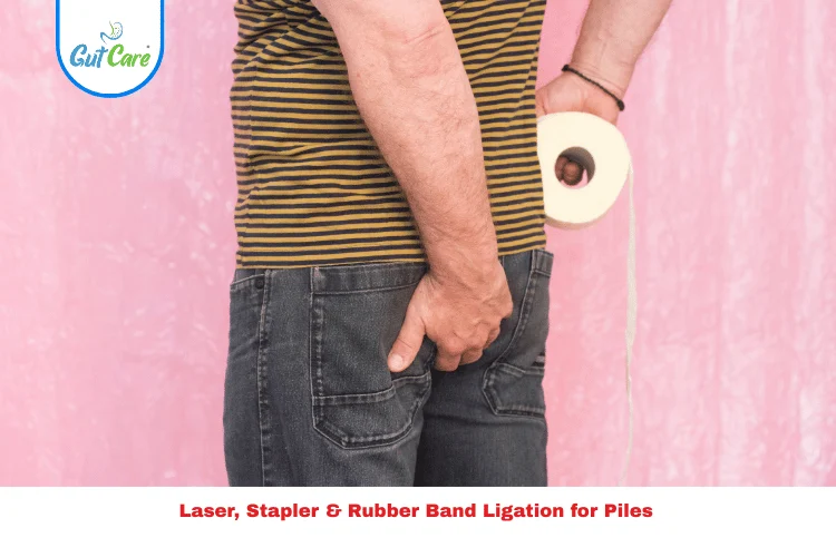 Rubber Band Ligation for Piles