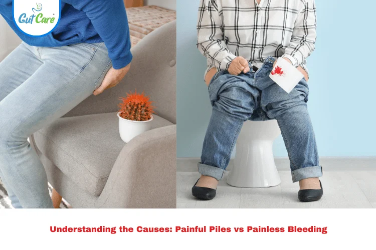 Painful Piles vs Painless Bleeding