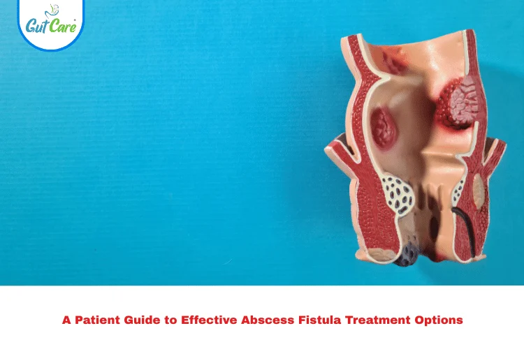 Abscess Fistula Treatment