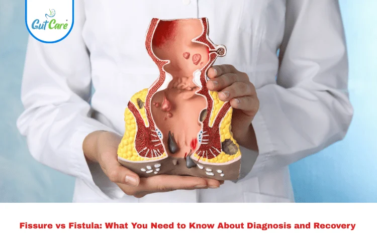 Fissure vs Fistula