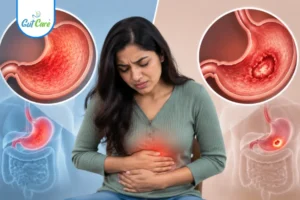 Gastritis vs Ulcer