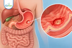 Peptic ulcer disease causes diagnosis and treatment at Gutcare Clinics Bangalore
