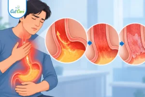 Barrett's Esophagus