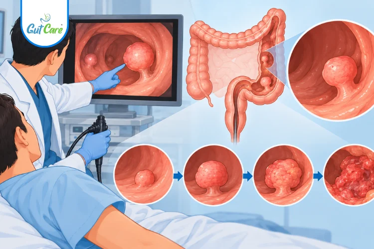 can colon polyps turn into cancer